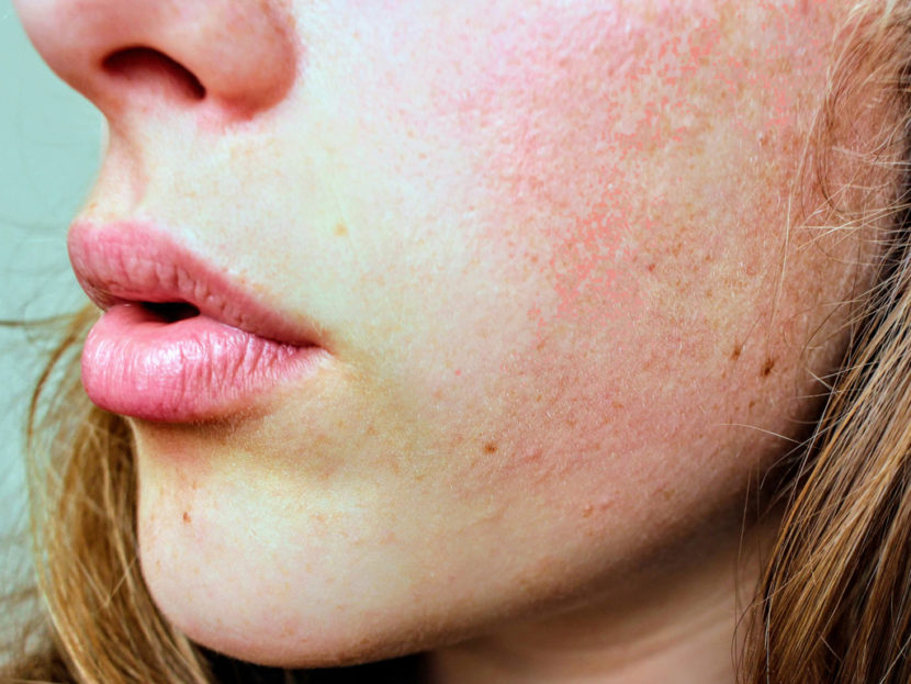 Rosacea